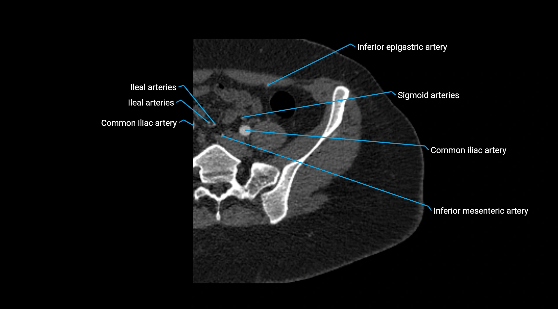 CTA lower limb cross sectional anatomy labelled image _17.webp